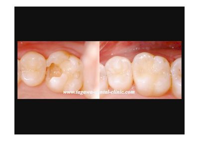 大臼歯隣接面の広い虫歯をダイレクトボンディングで治療した症例